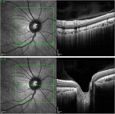 Virtual Reality Improves Clinical Assessment of the Optic Nerve